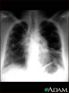 sarcoid-stage-iv-chest-x-ray